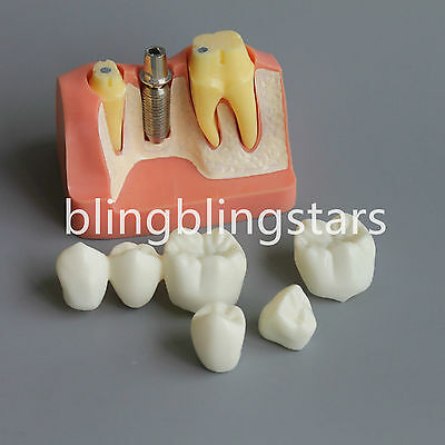 Brand New Dental Implant Analysis Crown Bridge Demonstration Study Teeth Model